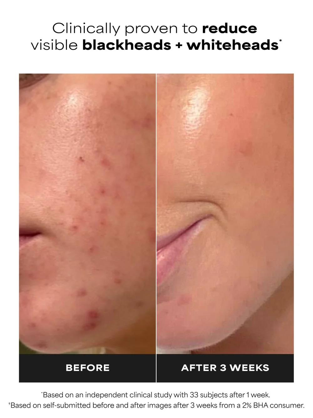 2% BHA Liquid Exfoliant - Detail